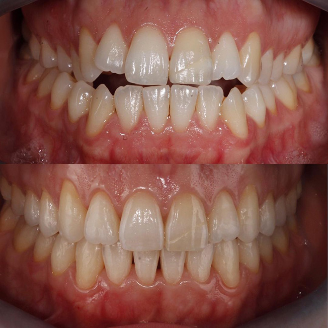 Spark Aligners before and after