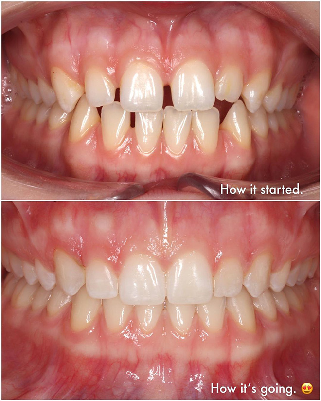 Spark Aligners before and after